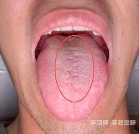 健康科普舌部异常感觉的医学解读 可能是这些健康信号舌头喷水怎么回事